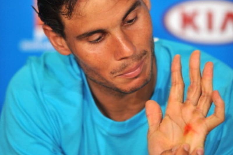 Rafael Nadal S Blistered Hand At Australian Open Match Looks Painful Bleacher Report Latest News Videos And Highlights